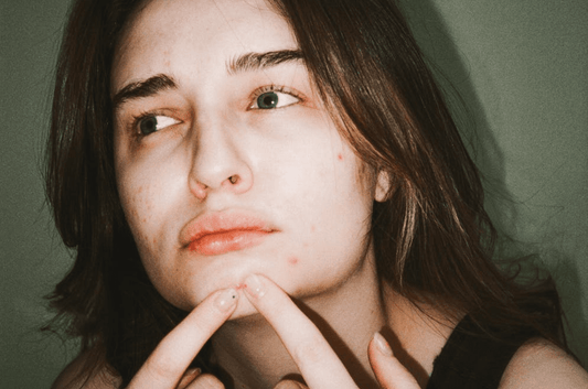 Le lien entre stress et acné – Ce que personne ne vous dit