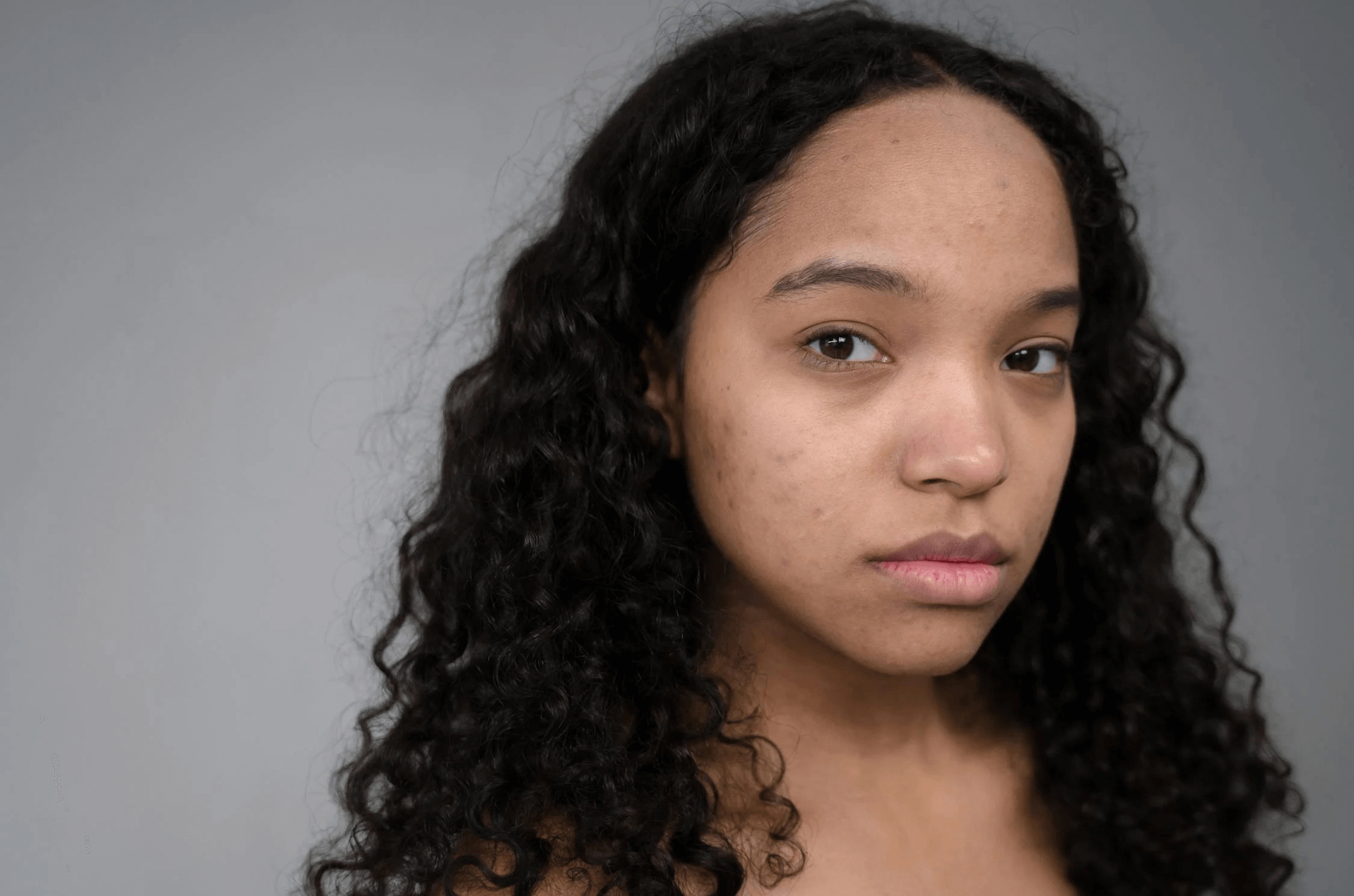 Les hormones responsables de l’acné hormonale Image