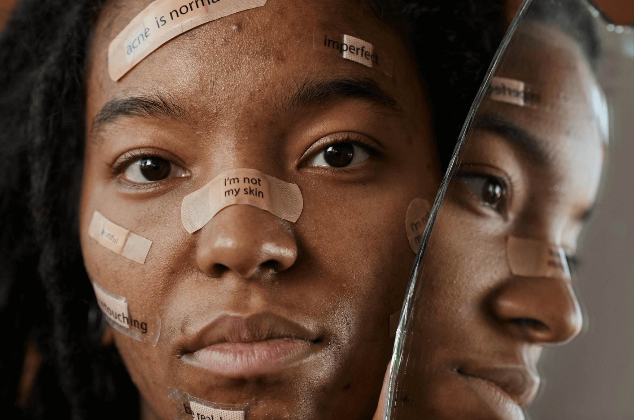 L’acné et la puberté : comprendre et apaiser les premiers bouleversements hormonaux Image