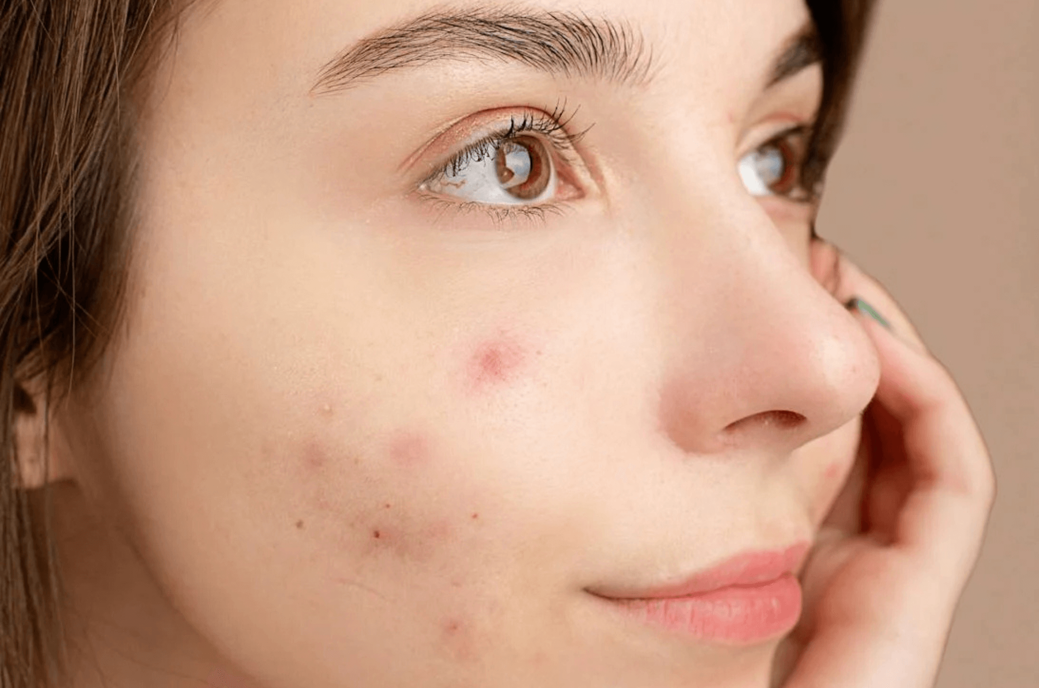 Les autres causes de l’acné : ce que vous ignorez peut vous aider Image