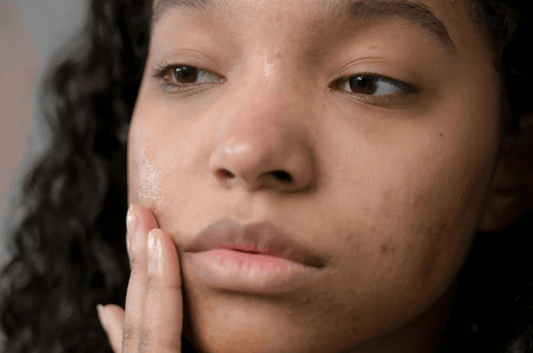 Mon acné me complexe… Voici comment j’ai retrouvé confiance