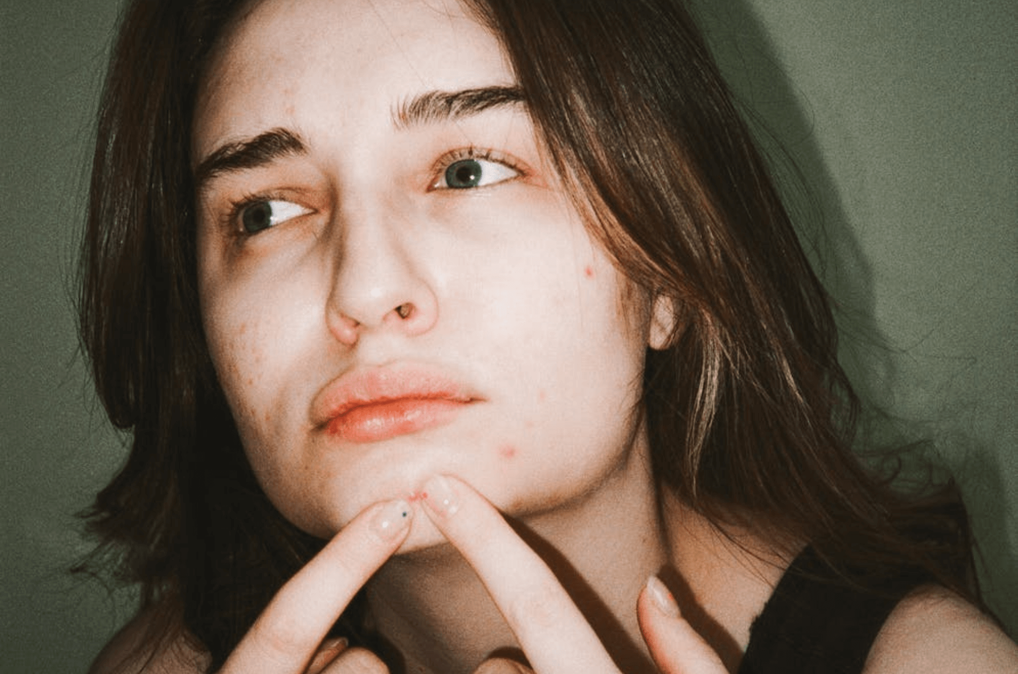 Le lien entre stress et acné – Ce que personne ne vous dit Image