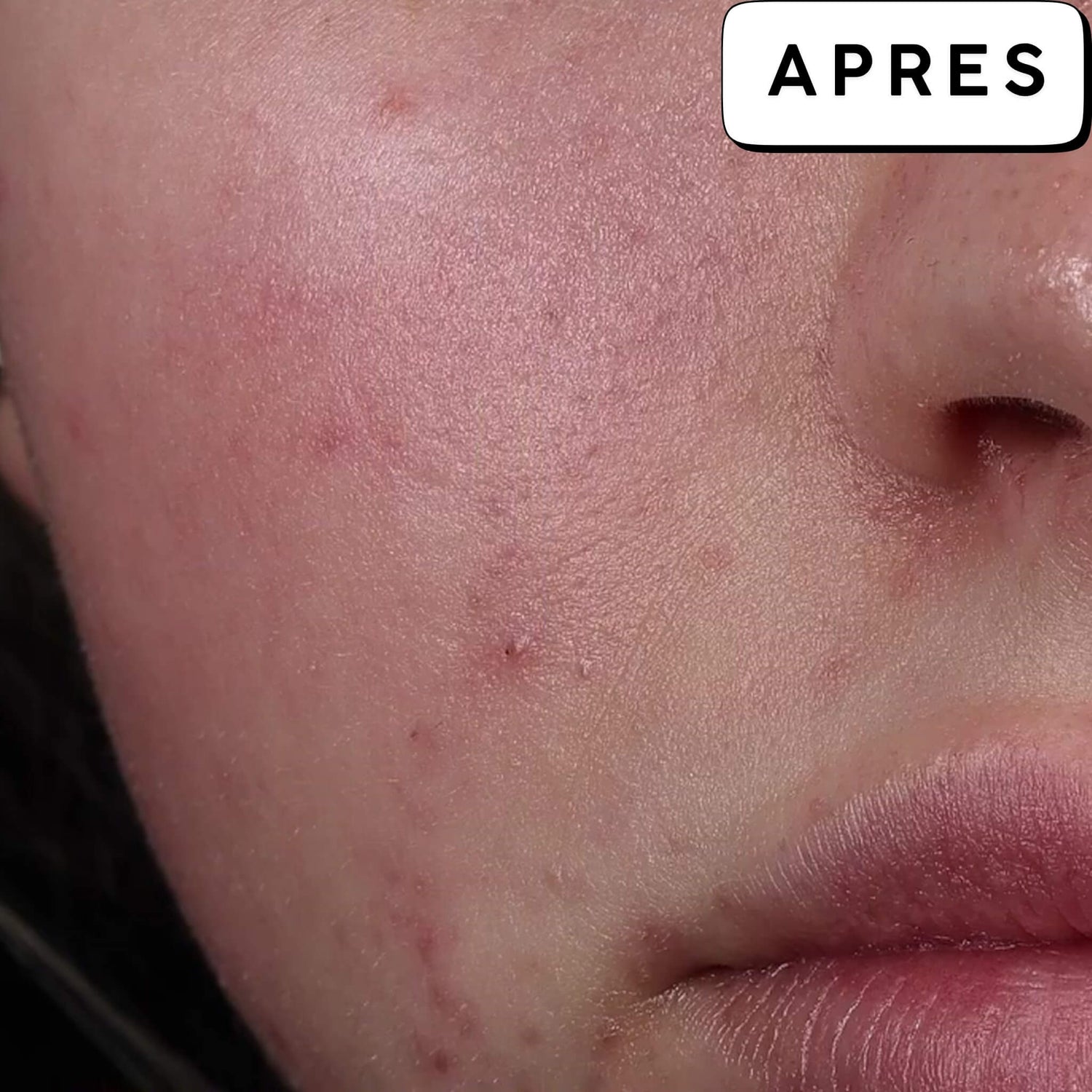 Après