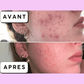 Calméa – Crème Bio pour Apaiser l’Acné Hormonale