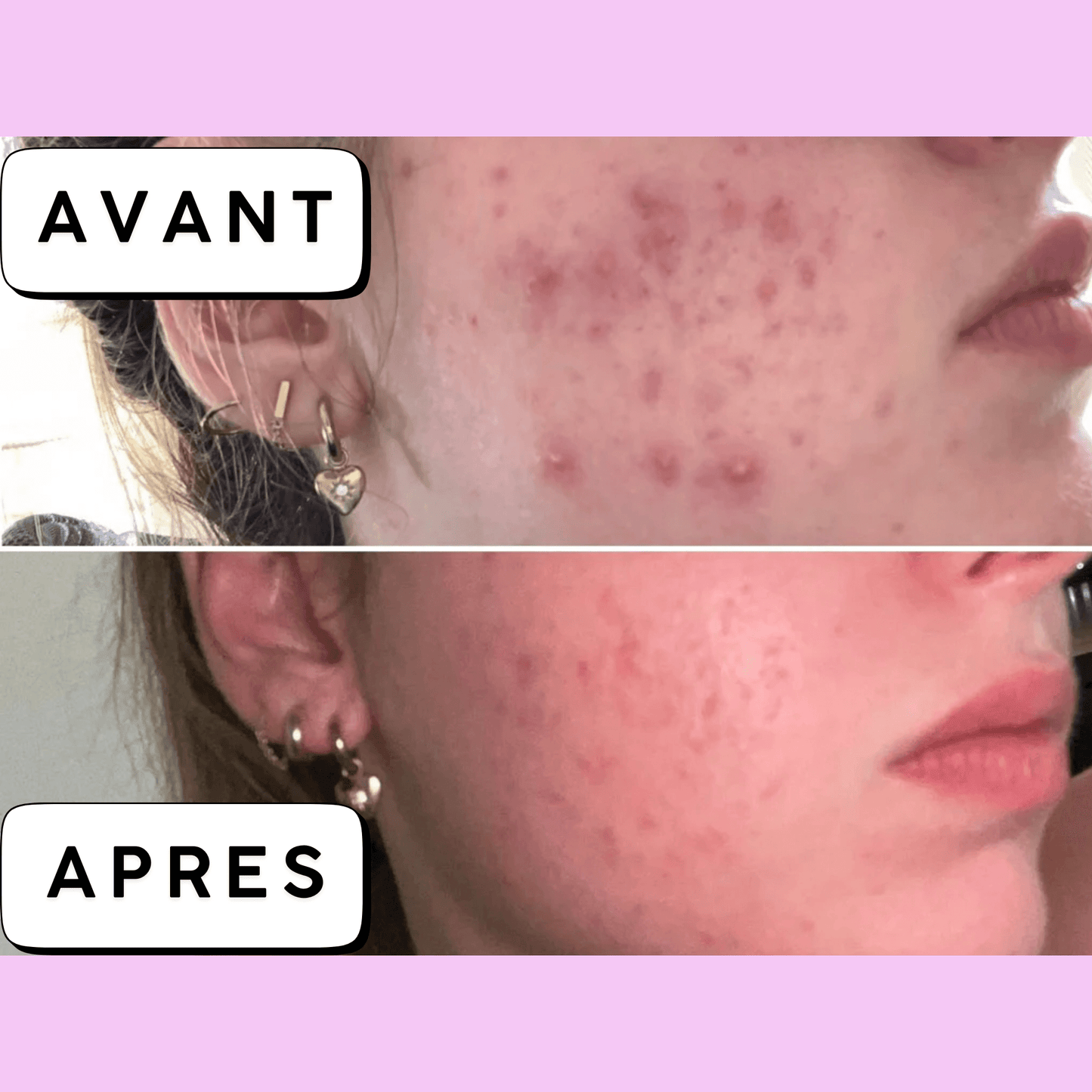 Calméa – Crème Bio pour Apaiser l’Acné Hormonale