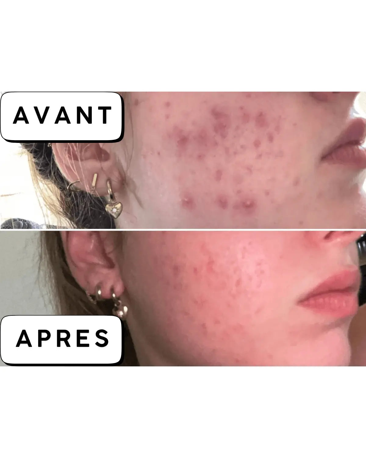 Calméa – Le soin ciblé apaisant d'anticipation pour les boutons avant les règles