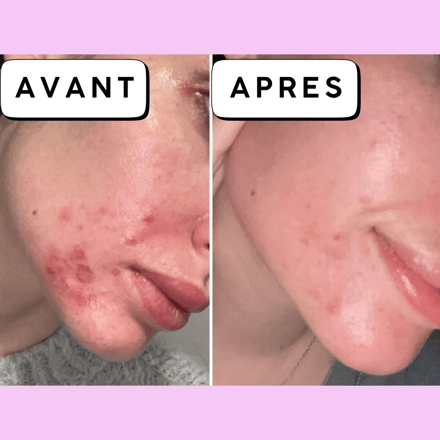 Calméa – Crème Bio pour Apaiser l’Acné Hormonale