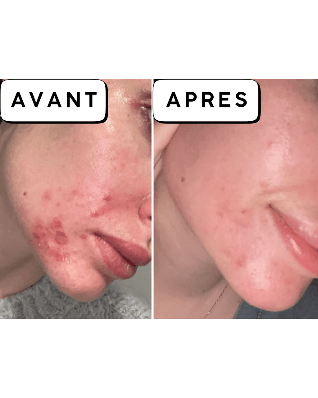 Calméa – Le soin apaisant pour les boutons avant les règles