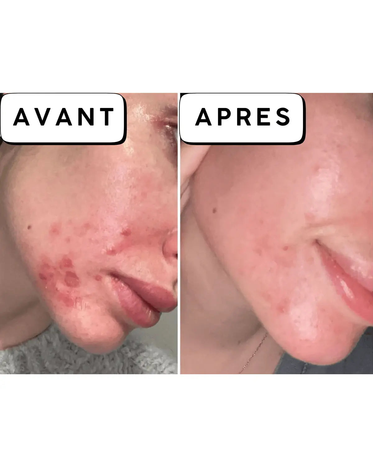 Calméa – Le soin ciblé apaisant d'anticipation pour les boutons avant les règles