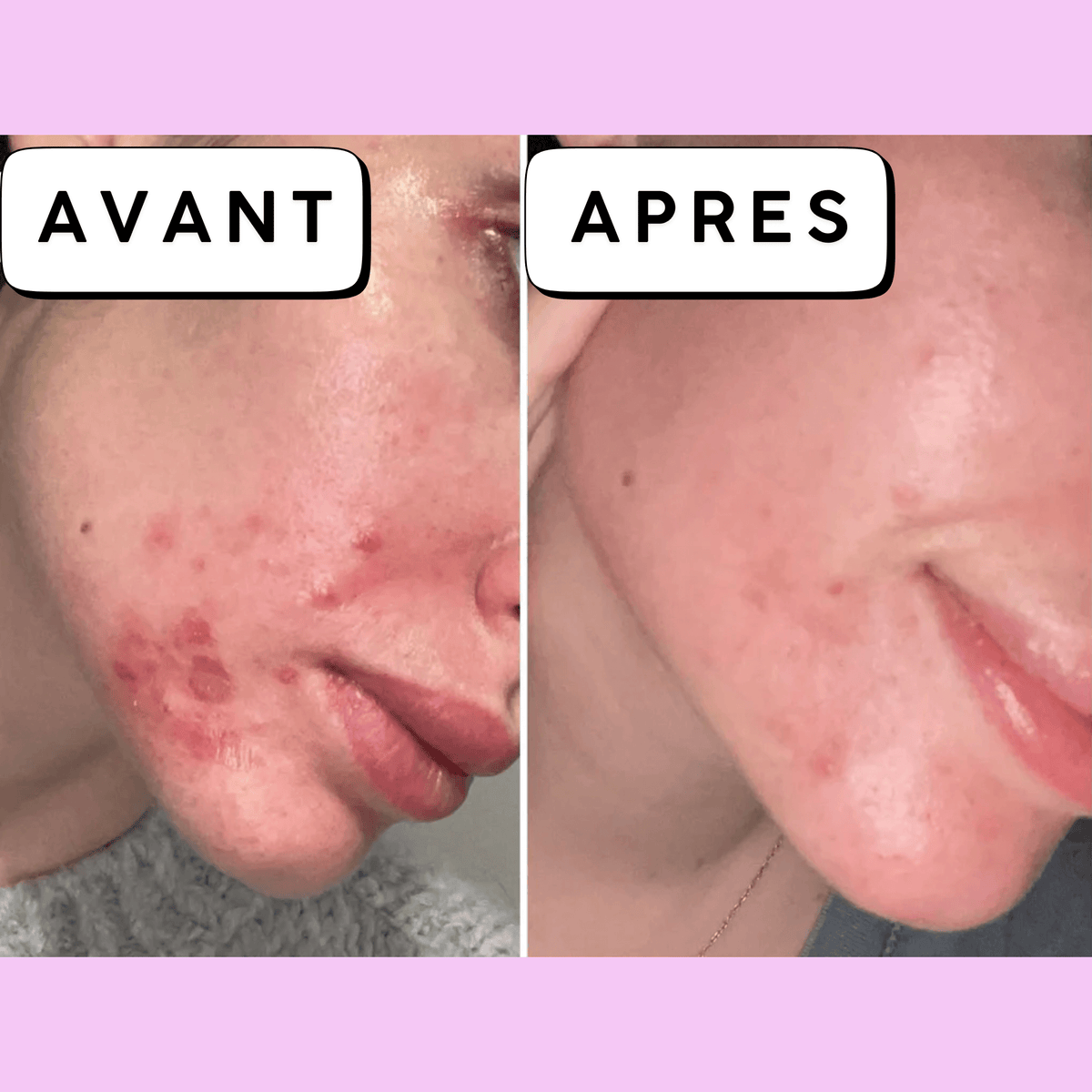 Calméa – Le soin apaisant pour les boutons avant les règles