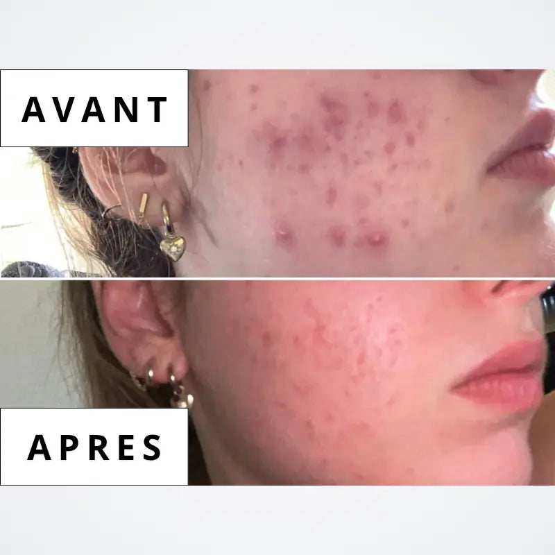 Sérum Calméa – Bouclier apaisant ciblé anti-inflammatoire