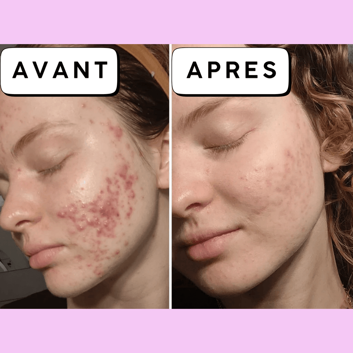 Calméa – Le soin apaisant pour les boutons avant les règles