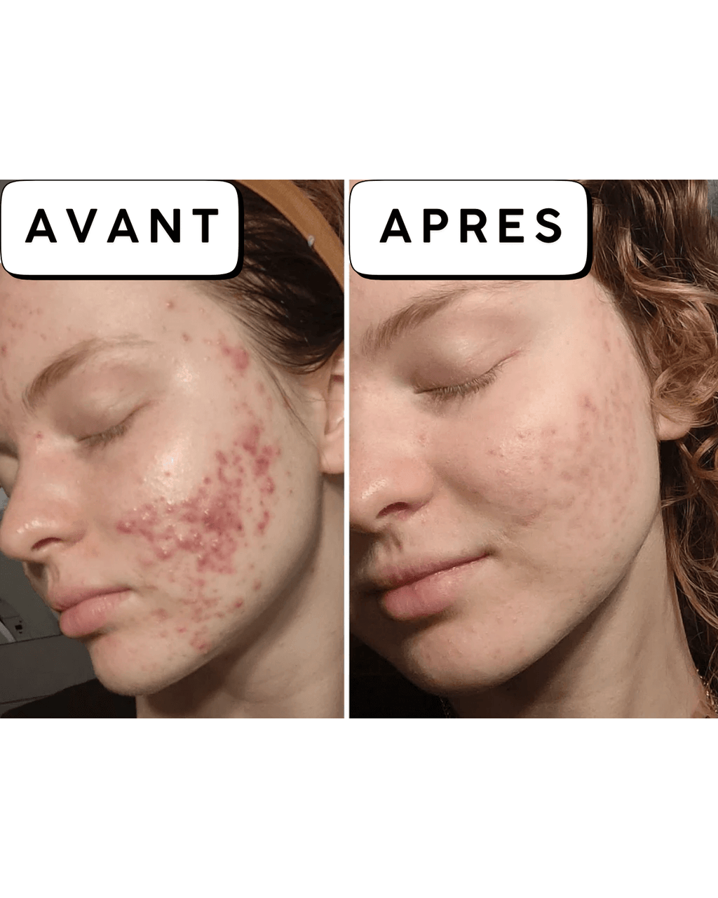 Calméa – Le soin apaisant pour les boutons avant les règles