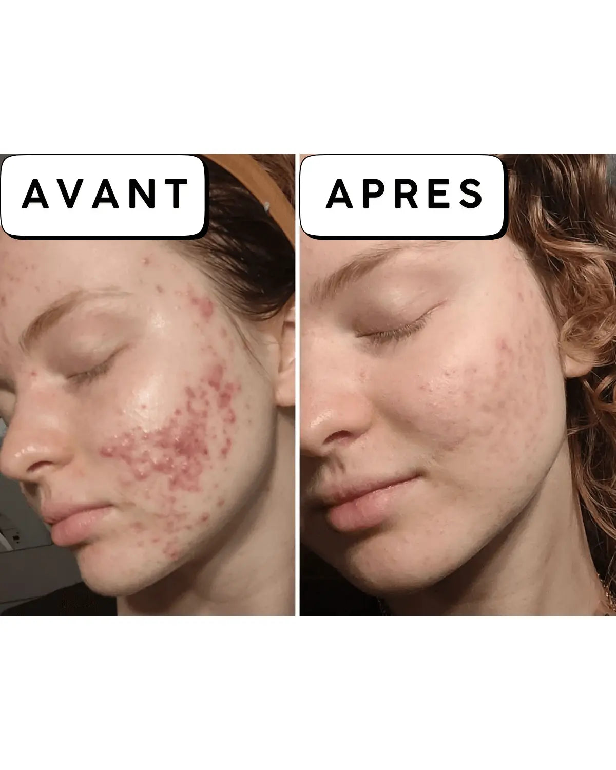 Calméa – Le soin ciblé apaisant d'anticipation pour les boutons avant les règles