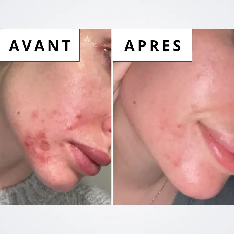 Sérum Calméa – Bouclier apaisant ciblé anti-inflammatoire