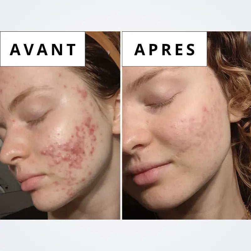 Sérum Calméa – Bouclier apaisant ciblé anti-inflammatoire